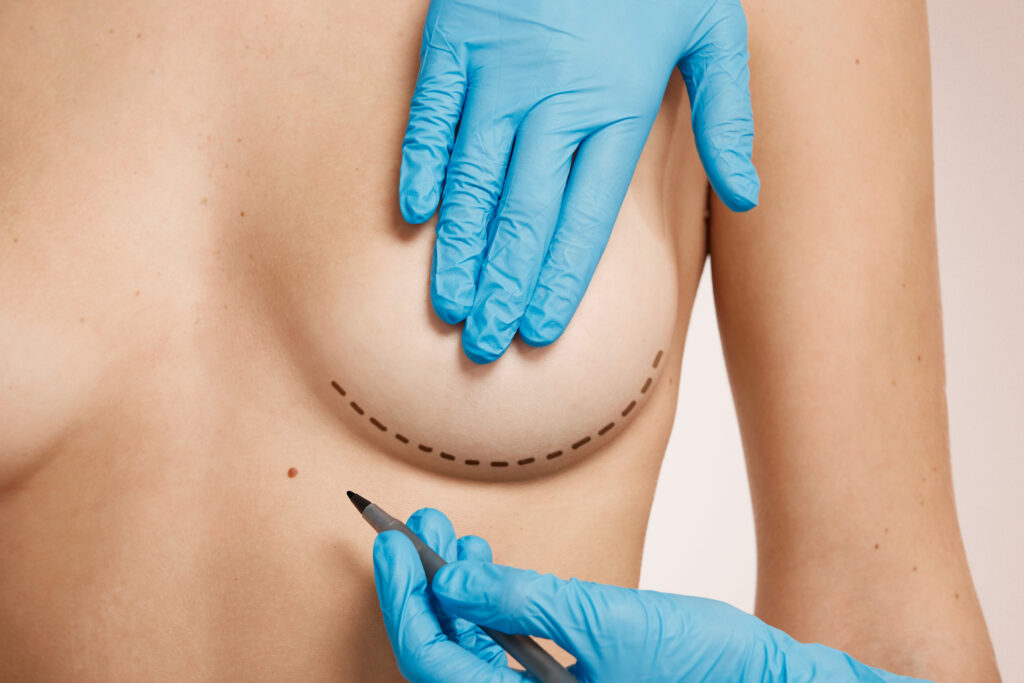 Breast lift surgery planning with surgical markings